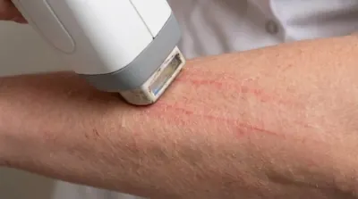 Laser without gel is dangerous