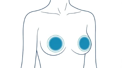 Diagram for Areolas