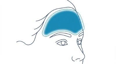 Diagram for Forehead